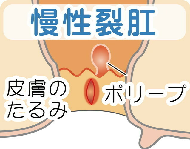 糖尿病の検査